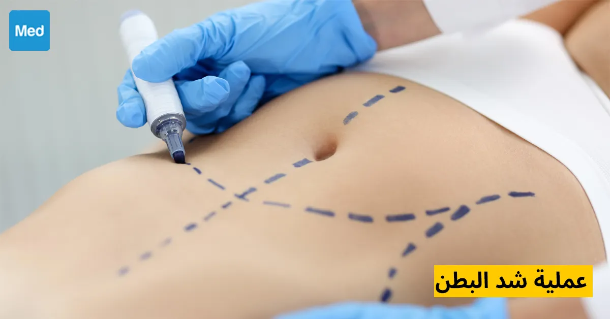 عملية شد البطن